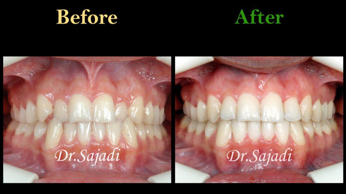 photo ۲۰۱۹ ۱۱ ۳۰ ۰۶ ۲۹ ۲۶ 1200x675 - درمان ارتودنسي ثابت دو فك بدون كشيدن دندان