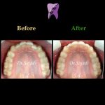 photo ۲۰۱۹ ۱۱ ۳۰ ۰۶ ۲۹ ۳۰ 150x150 - درمان ارتودنسي ثابت دو فك بدون كشيدن دندان