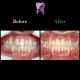 photo 2019 12 05 10 22 06 80x80 - درمان ارتودنسي برای انحراف خط وسط دندان