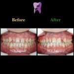 photo 2019 12 08 12 07 29 150x150 - درمان ارتودنسي برای انحراف خط وسط دندان