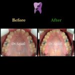 photo 2019 12 08 12 07 43 150x150 - درمان ارتودنسي برای انحراف خط وسط دندان