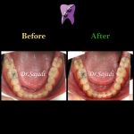 photo 2019 12 08 12 07 46 150x150 - درمان ارتودنسي برای انحراف خط وسط دندان
