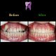 photo 2019 12 15 13 43 34 80x80 - درمان ارتودنسي برای انحراف خط وسط دندان