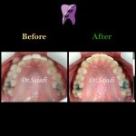 photo 2019 12 15 13 43 41 150x150 - درمان ارتودنسي برای كمبود فضا براي رويش دندان نيش