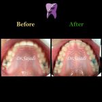 photo 2019 12 23 10 56 02 150x150 - درمان ارتودنسي بيمار با نارضايتي از بي نظمي دندان