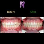 photo 2020 01 18 11 31 17 150x150 - درمان ارتودنسي بيمار با داشتن يك دندان اضافه در فك بالا