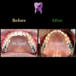 photo 2020 01 18 11 31 24 150x150 - درمان ارتودنسي بيمار با داشتن يك دندان اضافه در فك بالا