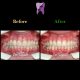 WhatsApp Image 2020 02 02 at 13.56.33 80x80 - درمان ارتودنسي بيمار با بالا بودن دندان نیش