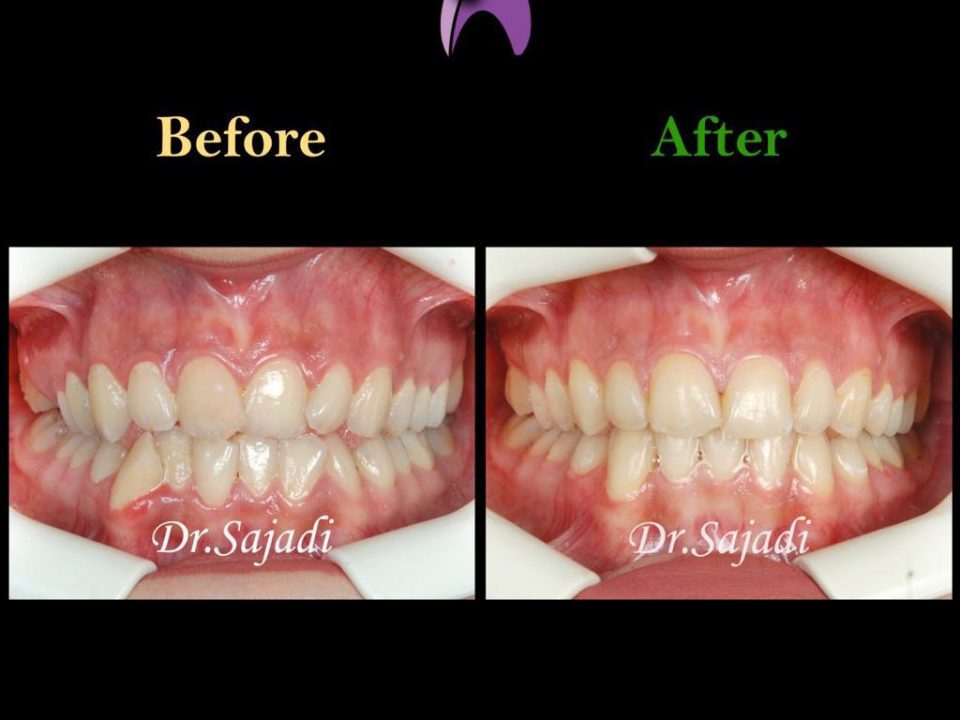 60435bc7 9306 4509 8a46 48d686300661 960x720 - درمان ارتودنسي بی نظمی دندان های فک پایین