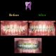 630110de e249 4d4b b50e e6a9e6af346b 80x80 - درمان ارتودنسي بی نظمی دندان های فک پایین