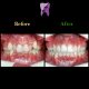 c0f10e00 3d0d 4caa 9b13 7e309d8250a2 80x80 - درمان ارتودنسي بی نظمی دندان های فک پایین