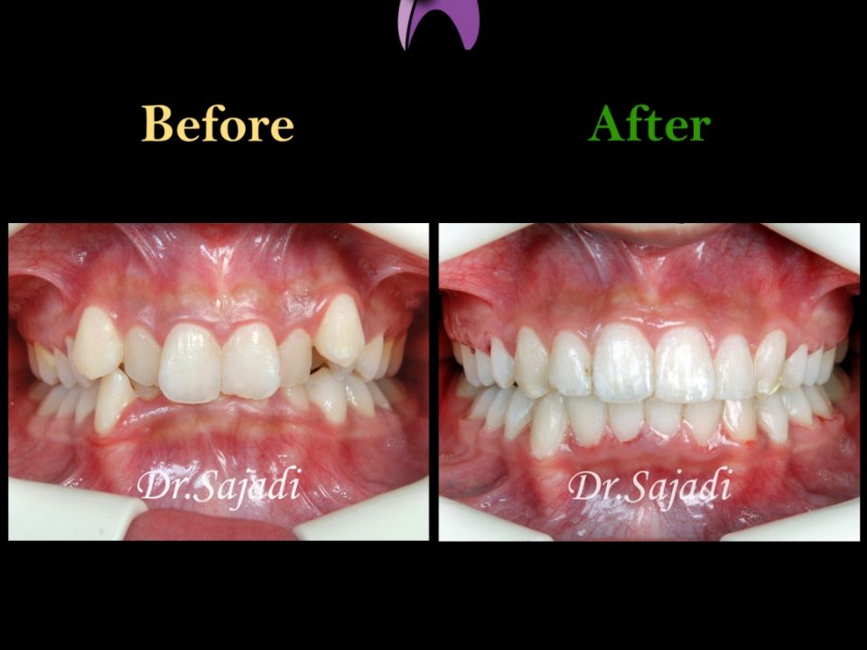 c0f10e00 3d0d 4caa 9b13 7e309d8250a2 960x720 - درمان ارتودنسي بی نظمی شدید بدون کشیدن دندان
