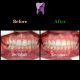 5 80x80 - درمان ارتودنسي فاصله بین دندان های جلو