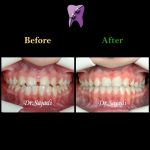 photo 2020 04 04 14 50 24 150x150 - درمان ارتودنسي فاصله بین دندان های جلو