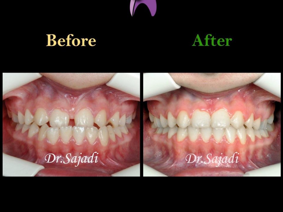 photo 2020 04 04 14 50 24 960x720 - درمان ارتودنسي فاصله بین دندان های جلو