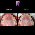 photo 2020 04 04 14 50 37 150x150 - درمان ارتودنسي فاصله بین دندان های جلو