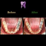 WhatsApp Image 2020 05 30 at 13.03.58 150x150 - درمان ارتودنسی بی نظمی دندان های فک پایین
