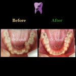 photo 2020 07 21 14 56 05 150x150 - درمان ارتودنسی ثابت با کشیدن دندان