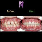 photo 2020 07 21 14 56 14 150x150 - درمان ارتودنسی ثابت با کشیدن دندان