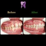 photo 2020 07 21 14 56 17 150x150 - درمان ارتودنسی ثابت با کشیدن دندان