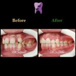 photo 2020 07 21 14 56 19 150x150 - درمان ارتودنسی ثابت با کشیدن دندان