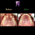 photo 2020 07 21 14 56 22 150x150 - درمان ارتودنسی ثابت با کشیدن دندان