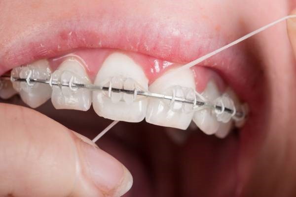 تمیز کردن دندان های ارتودنسی شده
