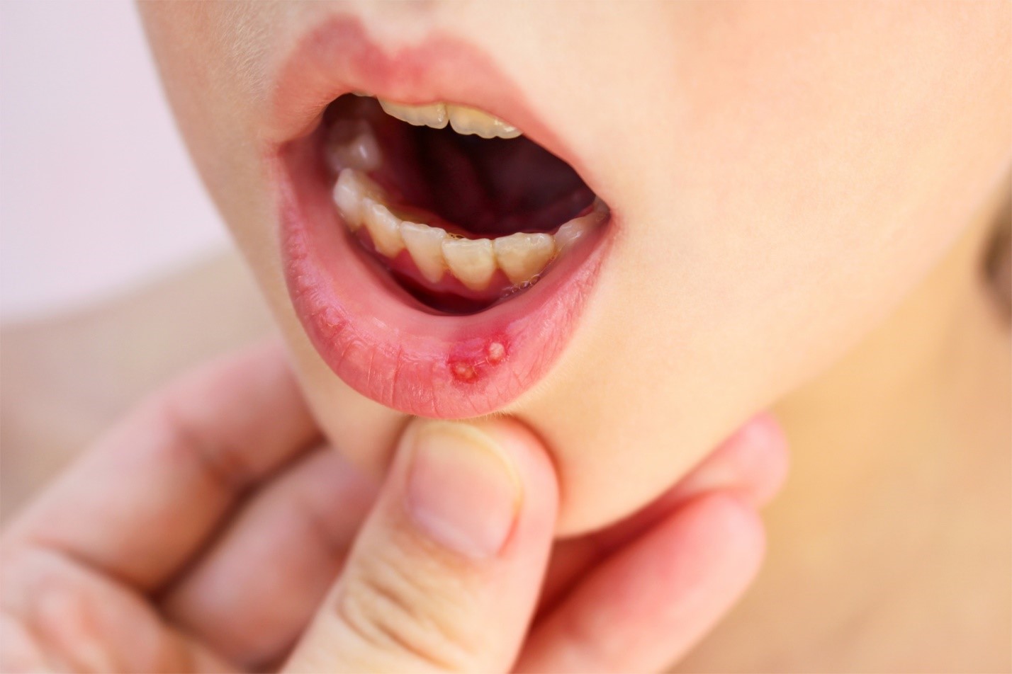 زخم دهان ناشی از براکت ارتودنسی
