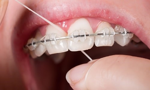 آیا براکت ارتودنسی دندانها را لک می‌کند؟