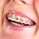 24 80x80 - درمان دندان نهفته با ارتودنسی