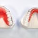 33 80x80 - آیا براکت ارتودنسی دندانها را لک می‌کند؟