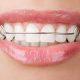 4 80x80 - درمان خشکی دهان در طی درمان ارتودنسی
