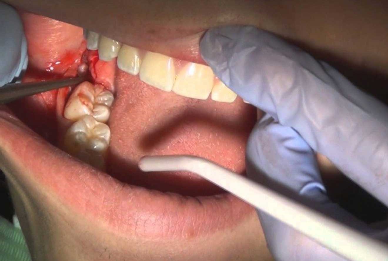 درمان دندان نهفته با ارتودنسی