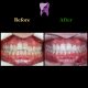 WhatsApp Image 2021 02 15 at 14.35.35 2 80x80 - درمان ارتودنسی ثابت دو فک بدون کشیدن دندان برای تامین زیبایی لب