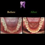 WhatsApp Image 2021 02 15 at 14.40.42 150x150 - درمان ارتودنسی ثابت دو فک بدون کشیدن دندان برای تامین زیبایی لب