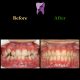 WhatsApp Image 2021 02 15 at 14.55.20 1 80x80 - درمان ارتودنسی ثابت دو فک بدون کشیدن دندان برای تامین زیبایی لب