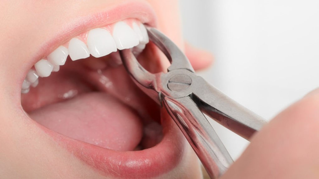 15 - کشیدن دندان های سالم در طول درمان ارتودنسی