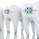 5 80x80 - کشیدن دندان های سالم در طول درمان ارتودنسی