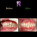 photo 2021 03 15 12 36 41 150x150 - ارتودنسی ثابت دو فک بدون کشیدن دندان برای اصلاح لبخند