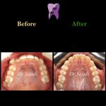 photo 2021 03 15 12 37 00 150x150 - ارتودنسی ثابت دو فک بدون کشیدن دندان برای اصلاح لبخند