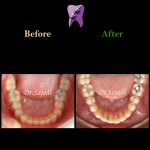 photo 2021 03 15 12 37 06 150x150 - ارتودنسی ثابت دو فک بدون کشیدن دندان برای اصلاح لبخند