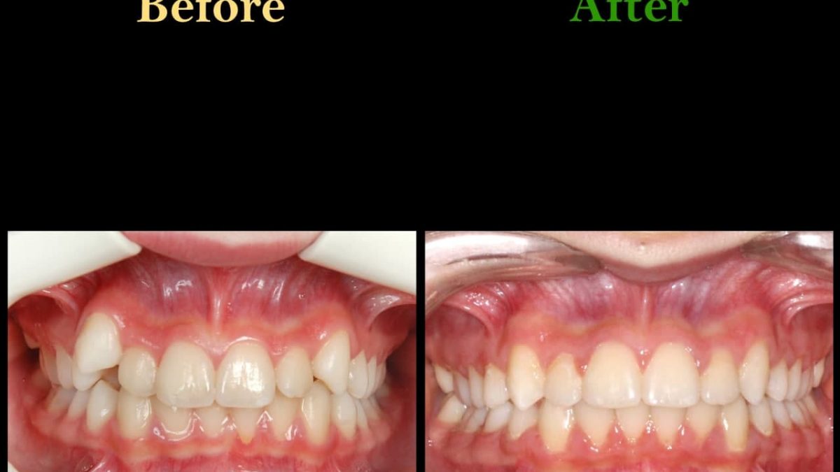 photo 2021 03 15 12 37 20 1200x675 - ارتودنسی ثابت دو فک بدون کشیدن دندان برای اصلاح لبخند