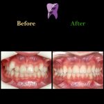 photo 2021 03 15 12 37 20 150x150 - ارتودنسی ثابت دو فک بدون کشیدن دندان برای اصلاح لبخند