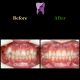 photo 2021 03 15 12 37 20 80x80 - ارتودنسی ثابت دو فک برای اصلاح جفت شدن دندان ها/درمان اپن بایت طرفی