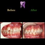 photo 2021 03 15 12 37 24 150x150 - ارتودنسی ثابت دو فک بدون کشیدن دندان برای اصلاح لبخند