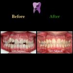 photo 2021 02 08 14 28 20 150x150 - ارتودنسی ثابت دو فک برای اصلاح جفت شدن دندان ها/درمان اپن بایت طرفی