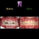 photo 2021 02 08 14 28 20 80x80 - ارتودنسی ثابت دو فک بدون کشیدن دندان برای اصلاح لبخند