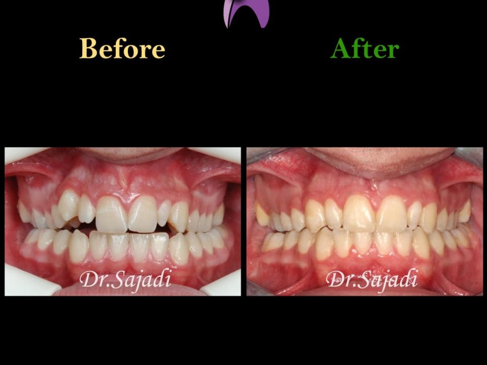 photo 2021 02 08 14 28 20 960x720 - ارتودنسی ثابت دو فک برای اصلاح جفت شدن دندان ها/درمان اپن بایت طرفی