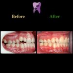 photo 2021 02 08 14 28 21 150x150 - ارتودنسی ثابت دو فک برای اصلاح جفت شدن دندان ها/درمان اپن بایت طرفی