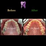 photo 2021 02 08 14 28 24 150x150 - ارتودنسی ثابت دو فک برای اصلاح جفت شدن دندان ها/درمان اپن بایت طرفی